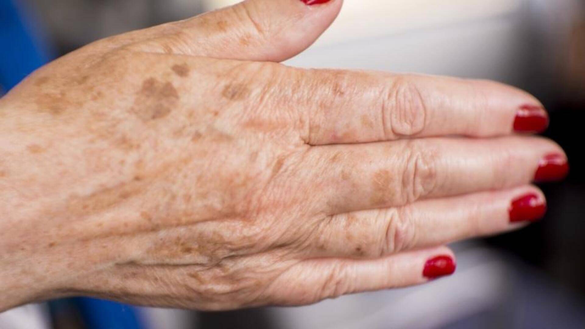 Melasma nas mãos: o que é e como diminuir