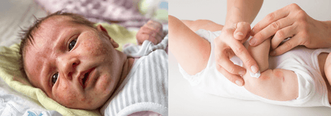 Acne neonatal: saiba o que é e como tratar as espinhas no bebê